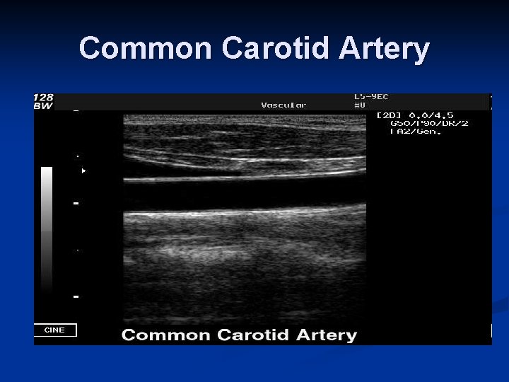 Common Carotid Artery 