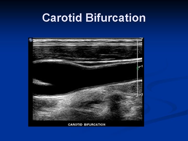 Carotid Bifurcation 