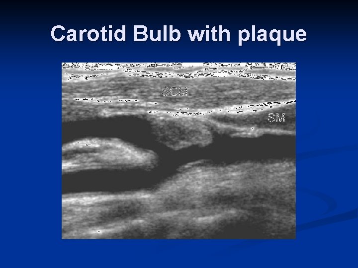 Carotid Bulb with plaque 