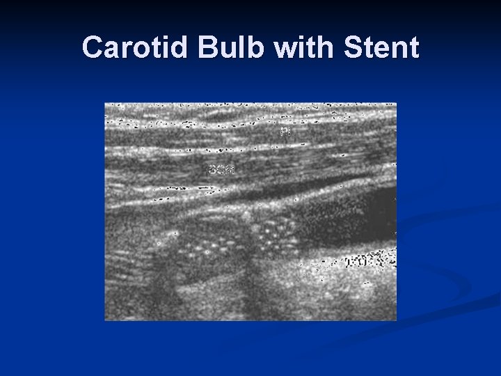 Carotid Bulb with Stent 