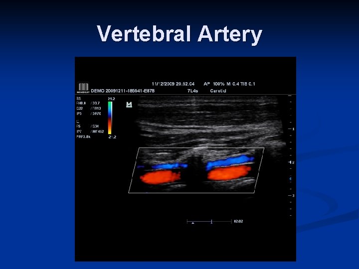 Vertebral Artery 