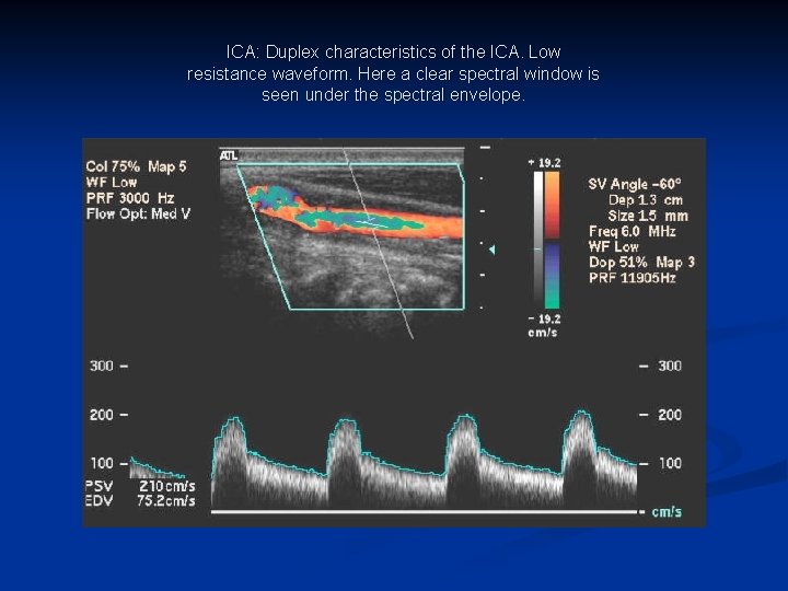ICA: Duplex characteristics of the ICA. Low resistance waveform. Here a clear spectral window