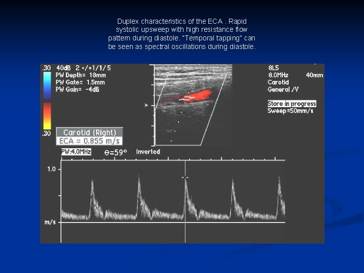 Duplex characteristics of the ECA. Rapid systolic upsweep with high resistance flow pattern during