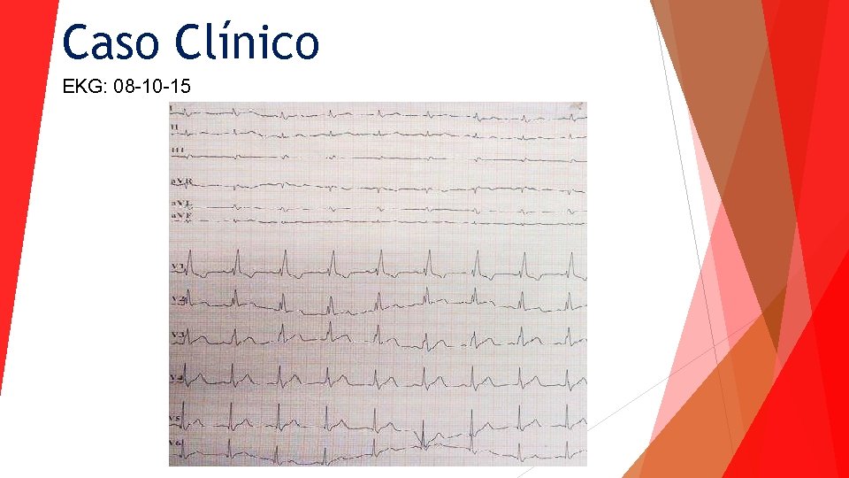 Caso Clínico EKG: 08 -10 -15 