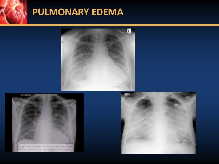 PULMONARY EDEMA 