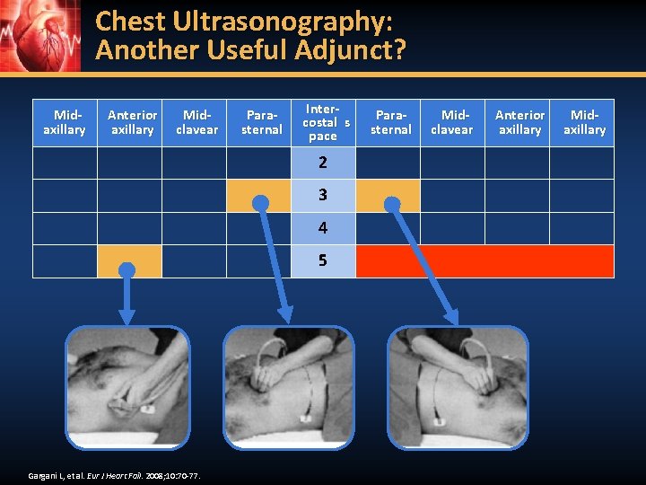 Chest Ultrasonography: Another Useful Adjunct? Midaxillary Anterior axillary Midclavear Parasternal Intercostal s pace 2