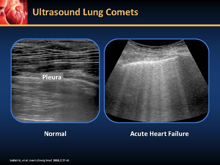 Ultrasound Lung Comets Pleura Normal Soldati G, et al. Intern Emerg Med. 2008; 3: