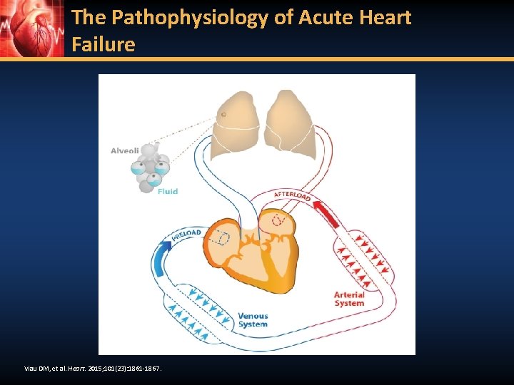 The Pathophysiology of Acute Heart Failure Viau DM, et al. Heart. 2015; 101(23): 1861