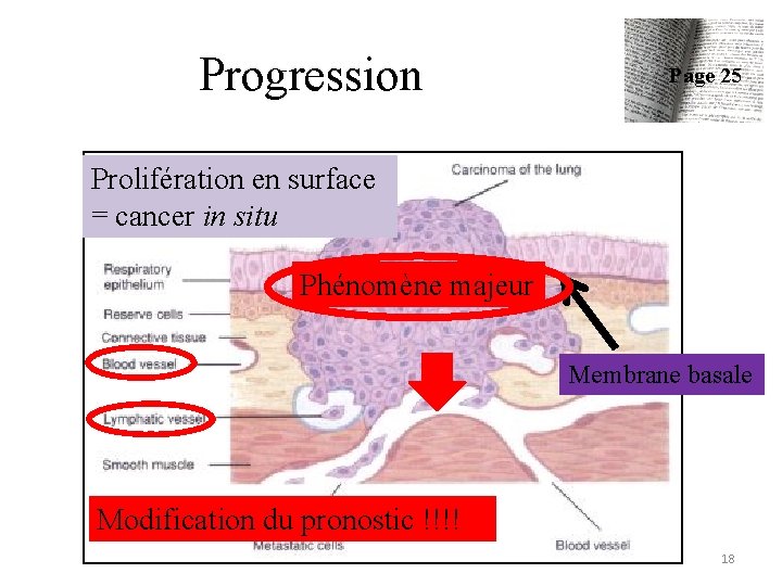 Progression Page 25 Prolifération en surface = cancer in situ Phénomène majeur Membrane basale