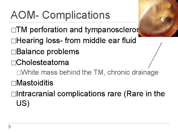 AOM- Complications �TM perforation and tympanosclerosis �Hearing loss- from middle ear fluid �Balance problems