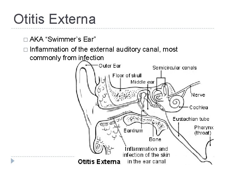 Otitis Externa � AKA “Swimmer’s Ear” � Inflammation of the external auditory canal, most