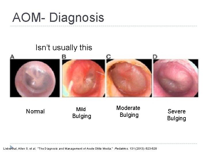 AOM- Diagnosis Isn’t usually this obvious Normal Mild Bulging Moderate Bulging Lieberthal, Allen S.