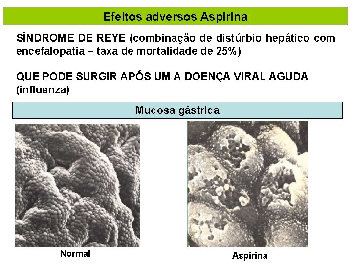 Efeitos adversos Aspirina SÍNDROME DE REYE (combinação de distúrbio hepático com encefalopatia – taxa