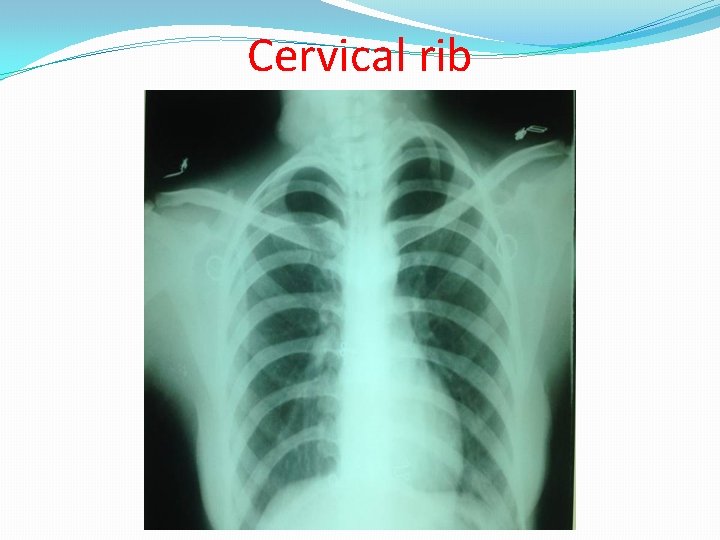 Abnormalities in CXR Presented by Ahmed Ebrahim Elmorsy