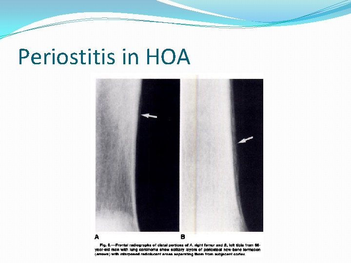 Periostitis in HOA 