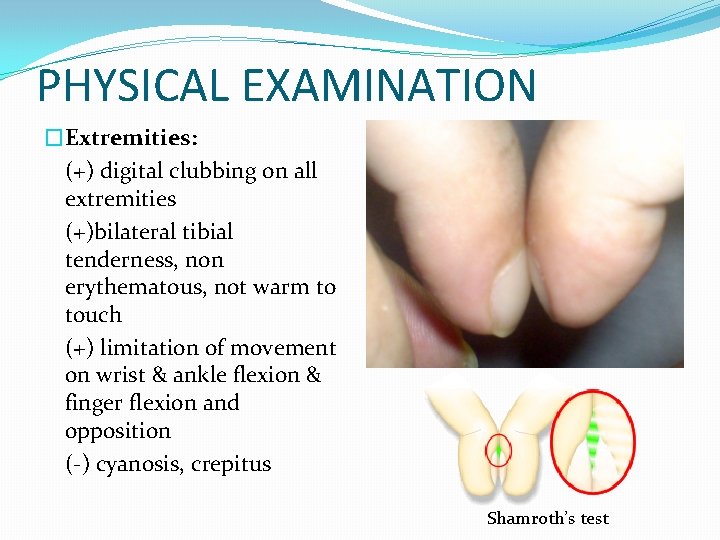 PHYSICAL EXAMINATION �Extremities: (+) digital clubbing on all extremities (+)bilateral tibial tenderness, non erythematous,