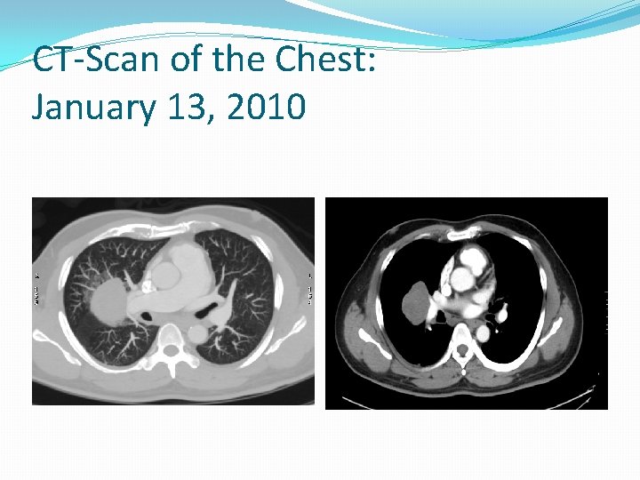 CT-Scan of the Chest: January 13, 2010 