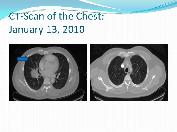 CT-Scan of the Chest: January 13, 2010 