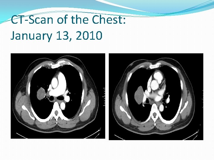 CT-Scan of the Chest: January 13, 2010 