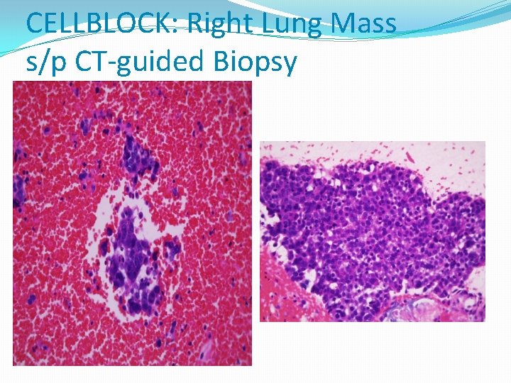 CELLBLOCK: Right Lung Mass s/p CT-guided Biopsy 