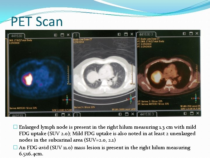 PET Scan � Enlarged lymph node is present in the right hilum measuring 1.