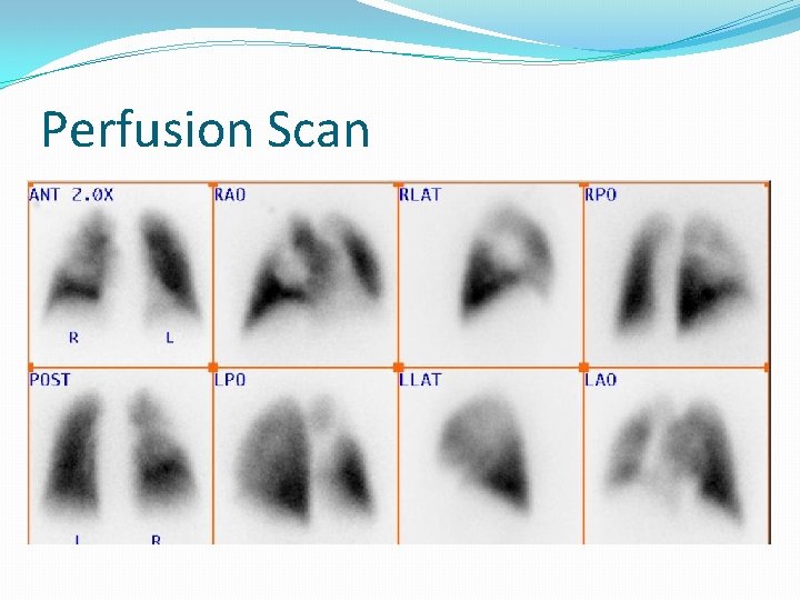 Perfusion Scan 