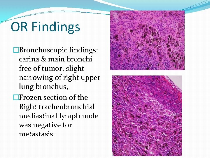 OR Findings �Bronchoscopic findings: carina & main bronchi free of tumor, slight narrowing of