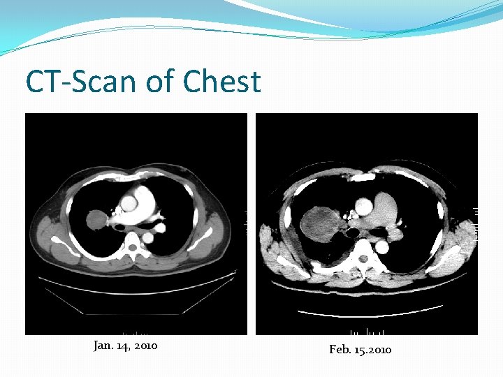 CT-Scan of Chest Jan. 14, 2010 Feb. 15. 2010 