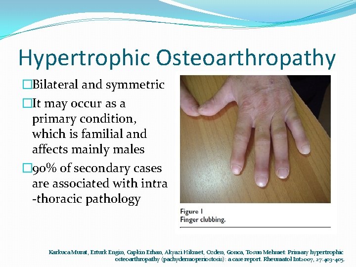 Hypertrophic Osteoarthropathy �Bilateral and symmetric �It may occur as a primary condition, which is