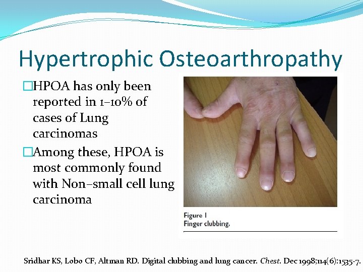 Hypertrophic Osteoarthropathy �HPOA has only been reported in 1– 10% of cases of Lung