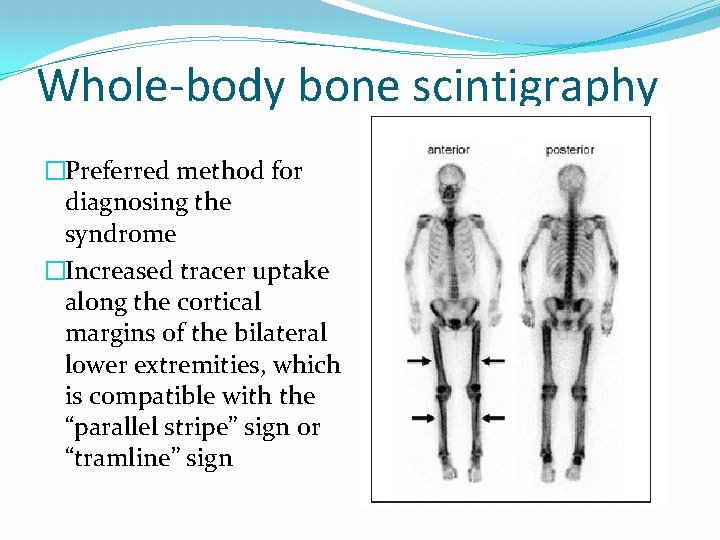 Whole-body bone scintigraphy �Preferred method for diagnosing the syndrome �Increased tracer uptake along the