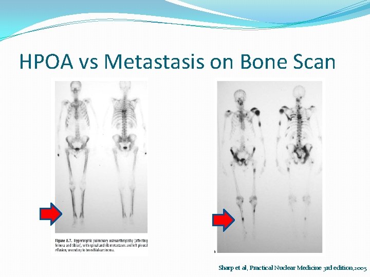 HPOA vs Metastasis on Bone Scan Sharp et al, Practical Nuclear Medicine 3 rd