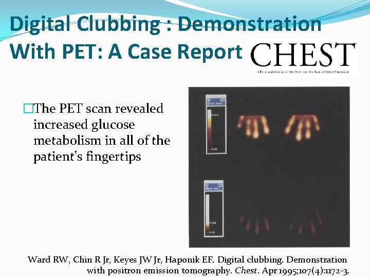 Digital Clubbing : Demonstration With PET: A Case Report �The PET scan revealed increased