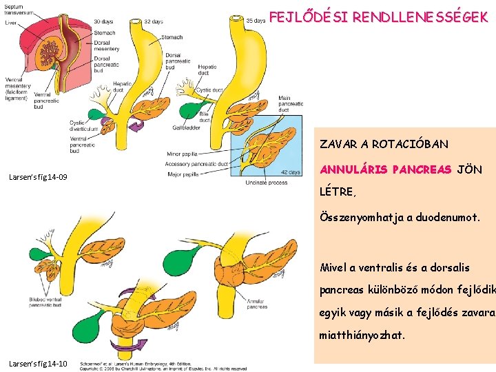 FEJLŐDÉSI RENDLLENESSÉGEK ZAVAR A ROTACIÓBAN Larsen’s fig 14 -09 ANNULÁRIS PANCREAS JÖN LÉTRE, Összenyomhatja