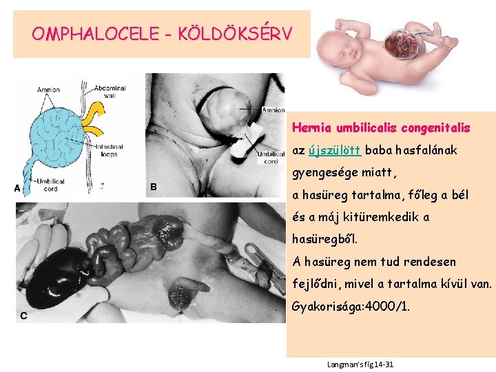 OMPHALOCELE - KÖLDÖKSÉRV Hernia umbilicalis congenitalis az újszülött baba hasfalának gyengesége miatt, a hasüreg