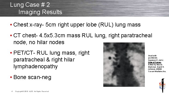 Lung Case # 2 Imaging Results • Chest x-ray- 5 cm right upper lobe