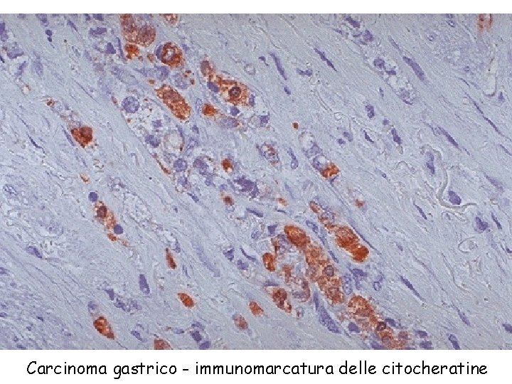 Carcinoma gastrico - immunomarcatura delle citocheratine 