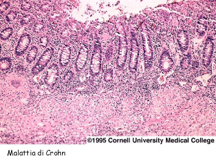 Malattia di Crohn 