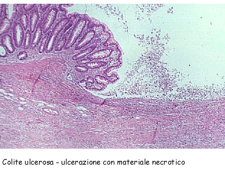 Colite ulcerosa - ulcerazione con materiale necrotico 