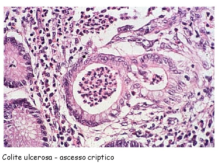 Colite ulcerosa - ascesso criptico 
