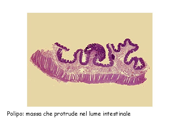 Polipo: massa che protrude nel lume intestinale 