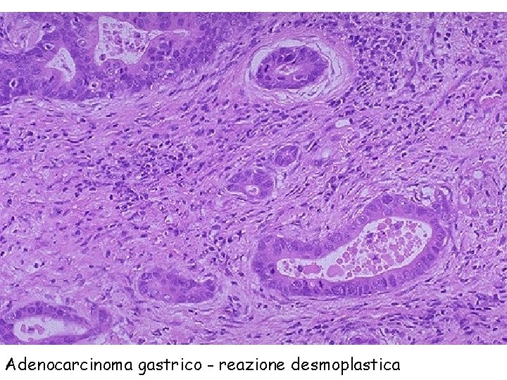 Adenocarcinoma gastrico - reazione desmoplastica 