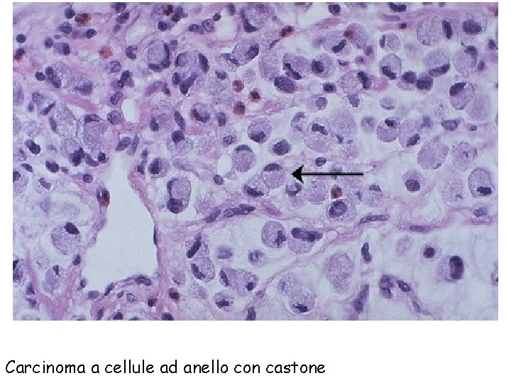 Carcinoma a cellule ad anello con castone 