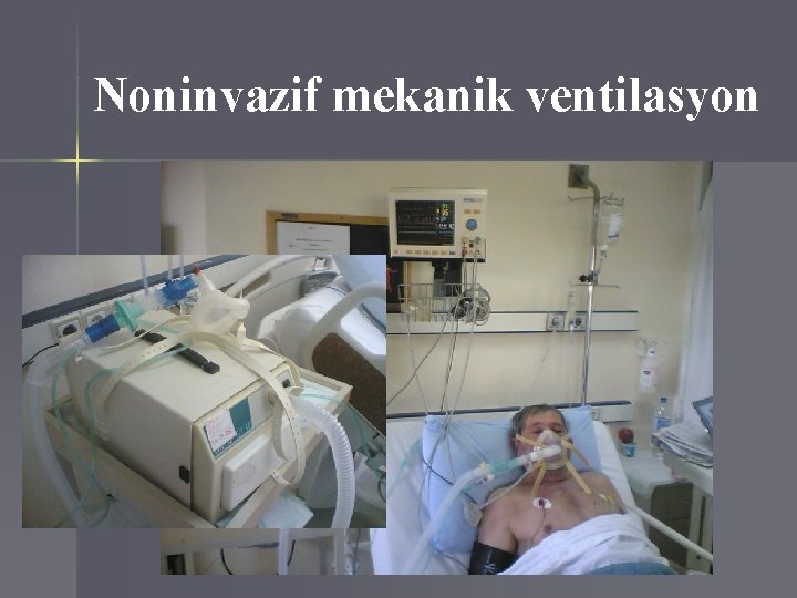 Noninvazif mekanik ventilasyon 