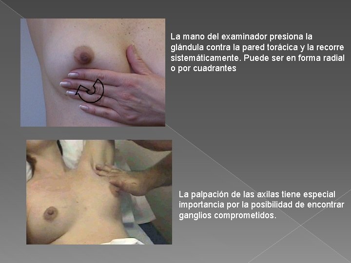 La mano del examinador presiona la glándula contra la pared torácica y la recorre