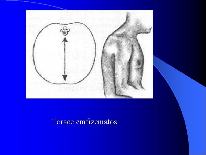 Torace emfizematos 