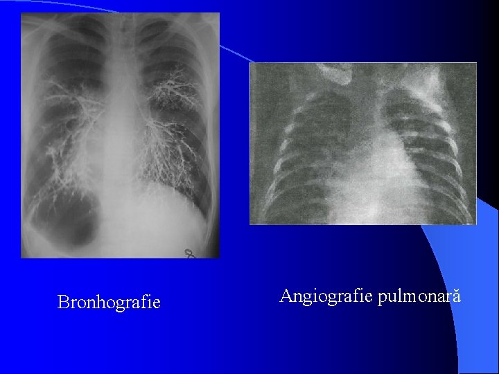 Bronhografie Angiografie pulmonară 