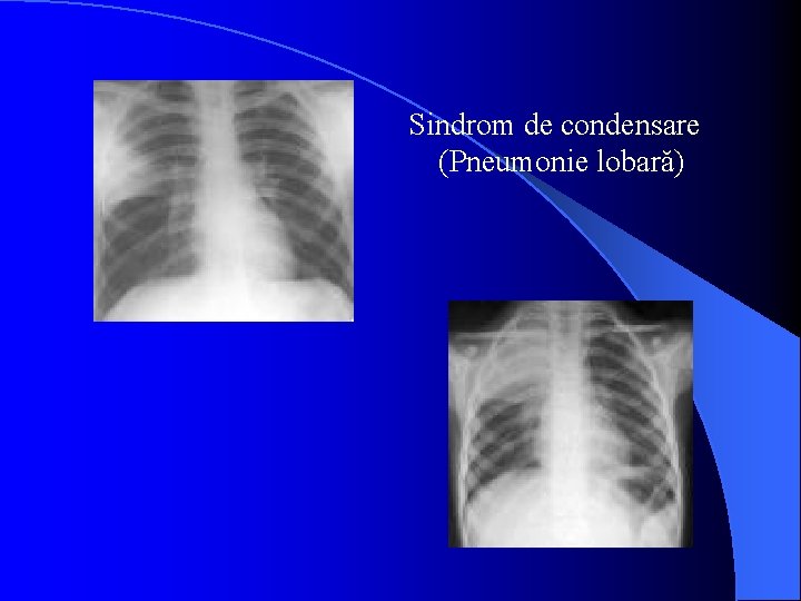 Sindrom de condensare (Pneumonie lobară) 