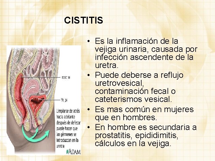 CISTITIS • Es la inflamación de la vejiga urinaria, causada por infección ascendente de