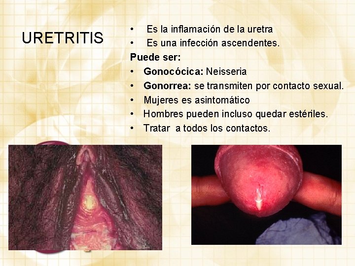 URETRITIS • Es la inflamación de la uretra • Es una infección ascendentes. Puede